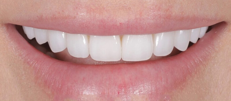 After - Veneers at Concord Dental & Orthodontics