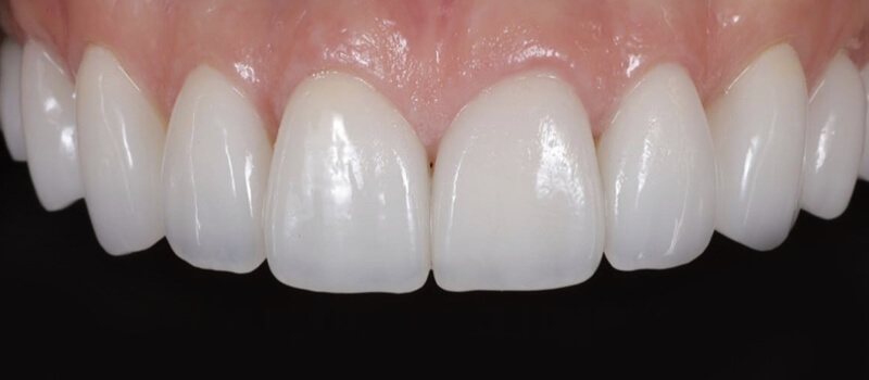 After - Veneers at Concord Dental & Orthodontics