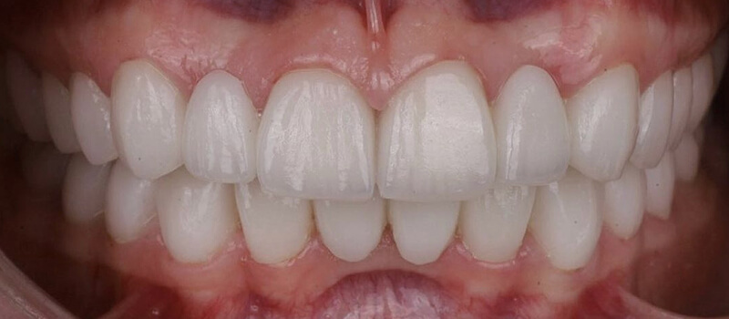 After - Veneers at Concord Dental & Orthodontics