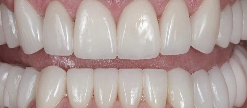 After - Veneers at Concord Dental & Orthodontics