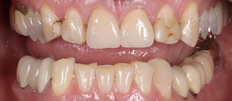 Before - Veneers at Concord Dental & Orthodontics