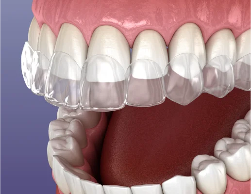 Clear Aligners