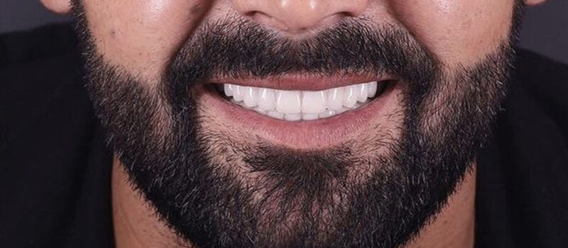 After - All-on-4 at Concord Dental & Orthodontics