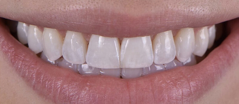 After - Invisalign at Concord Dental & Orthodontics