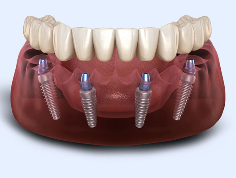 Revolutionary All-On-4® Technology