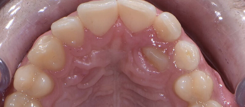 Before - Braces at Concord Dental & Orthodontics