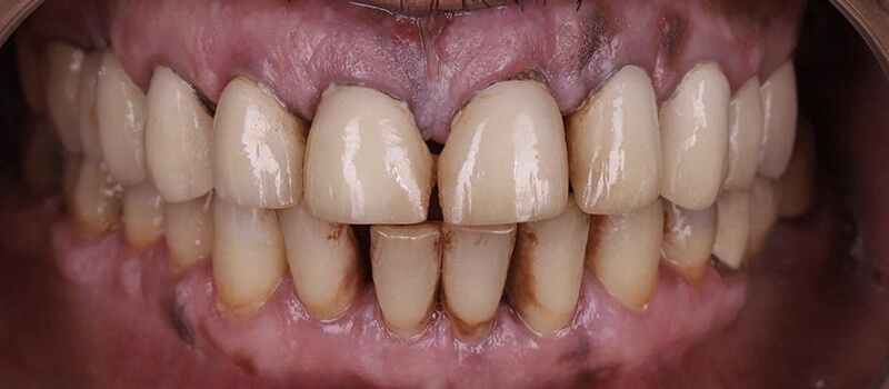 Before - All-on-4 at Concord Dental & Orthodontics
