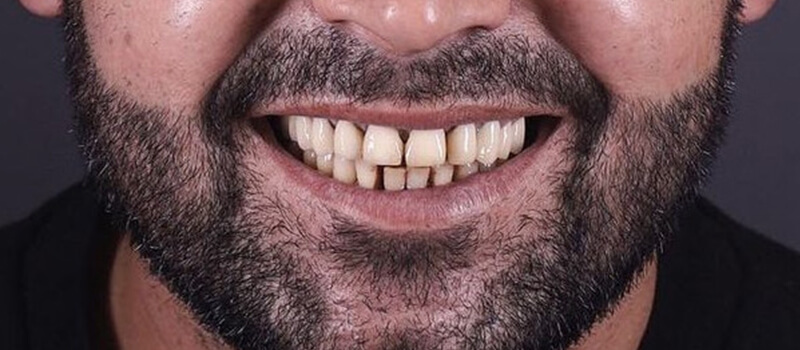 Before - All-on-4 at Concord Dental & Orthodontics