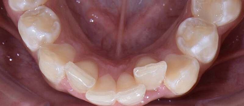 Before - Invisalign at Concord Dental & Orthodontics
