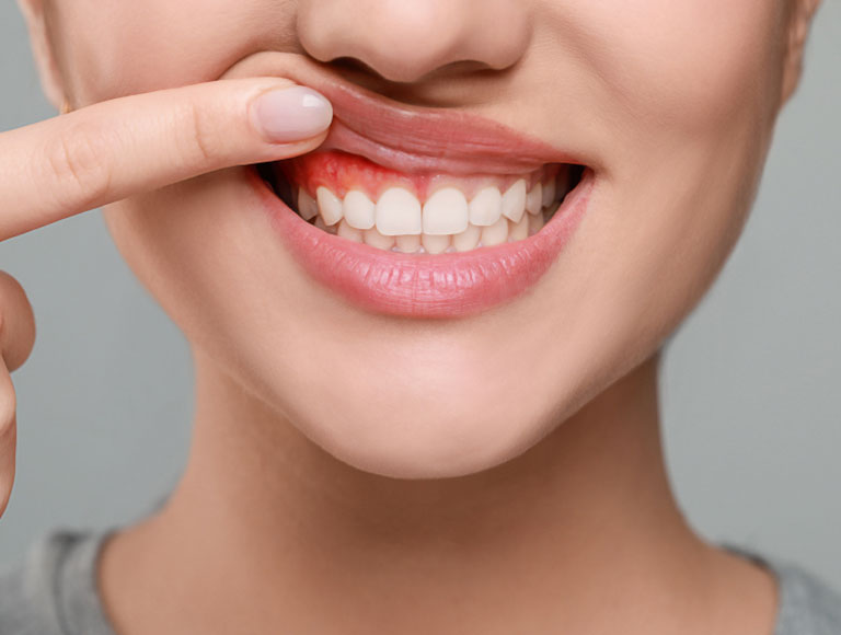 Are You at Risk for Gum Disease