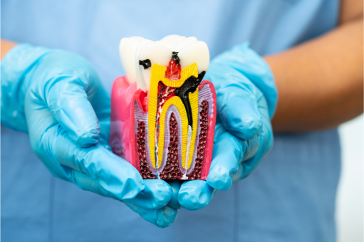 Root Canal Therapy