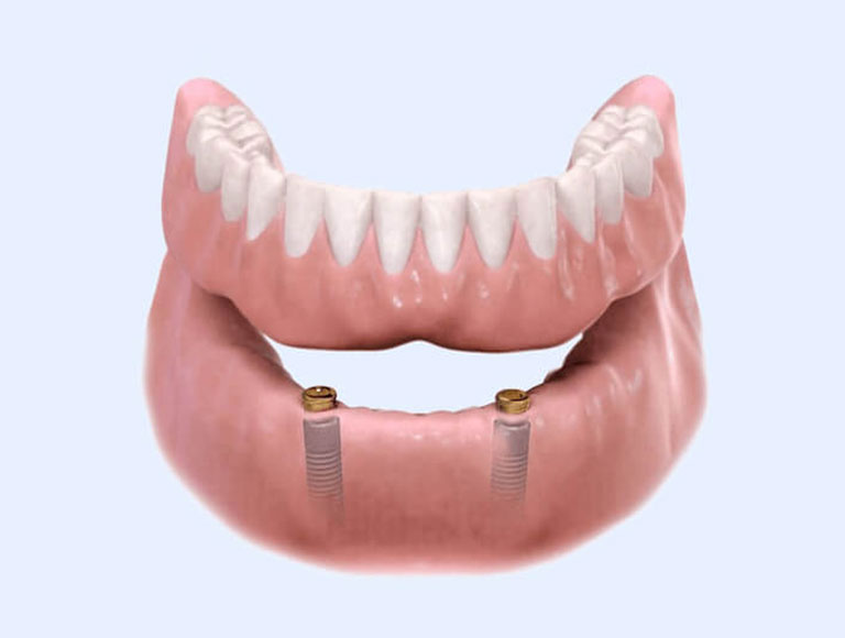 Fixed vs. Removable Implant Solutions