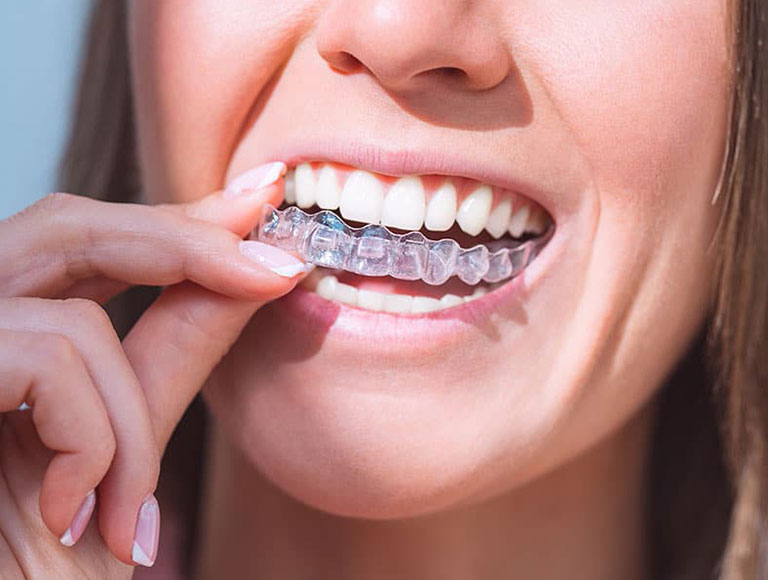ClearCorrect Aligners